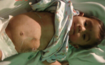 Neuropathic bladder Urinary stone in children Circumcision